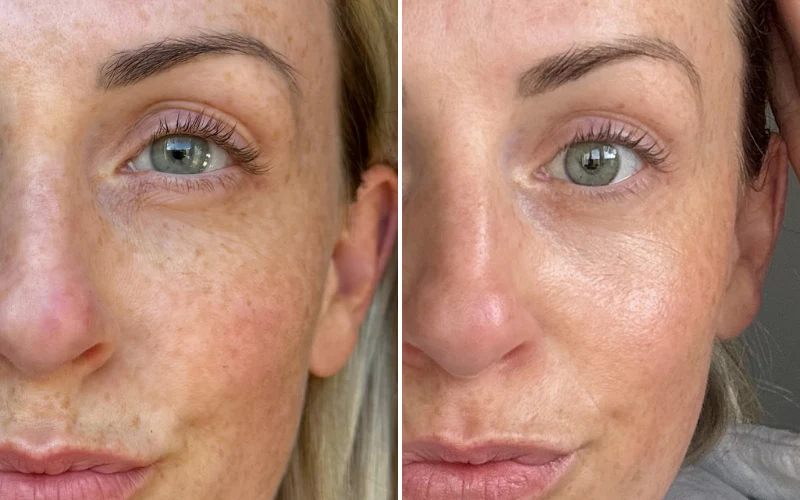 Cure 3 séances - Nanoneedling - Détail 2